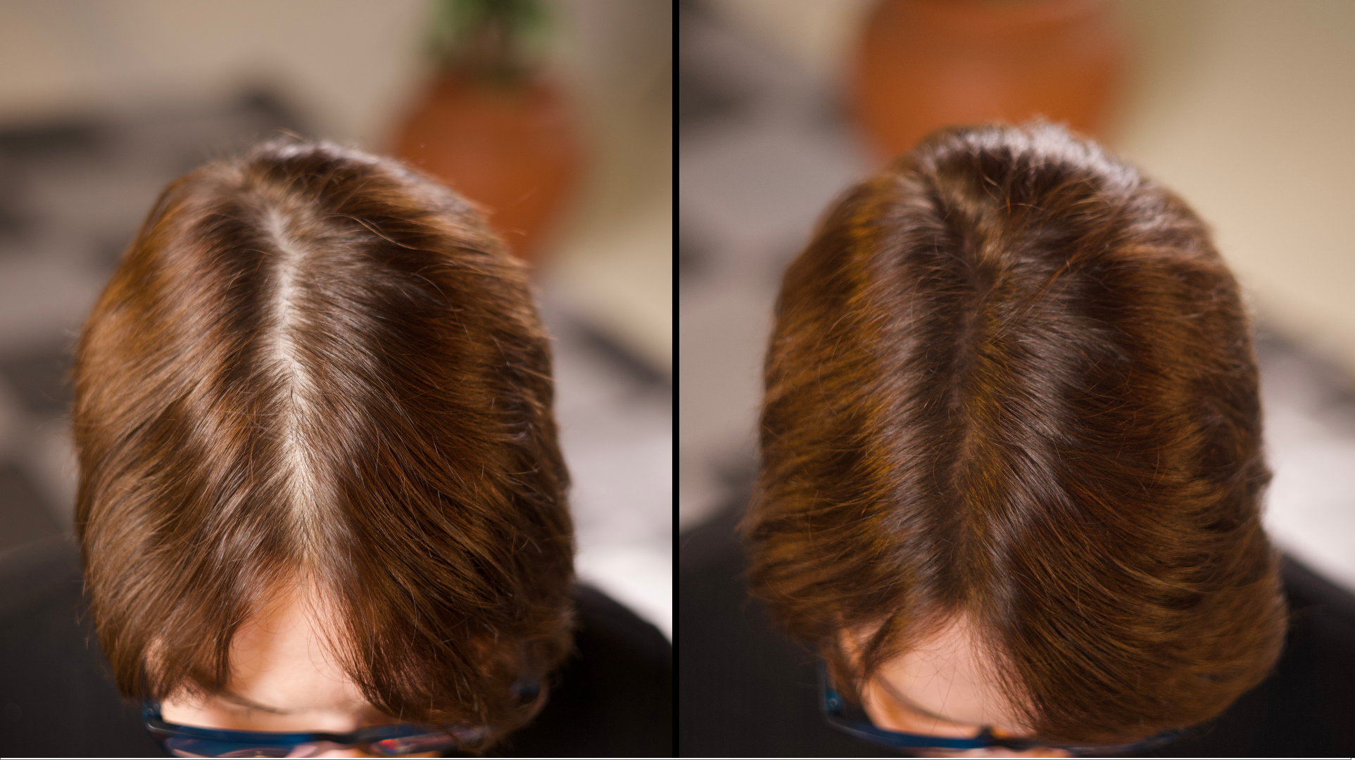 Hair Loss Treatment Online  Rosemary Health